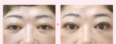 埋没法を繰り返したが希望の目にならなかった 症例写真4