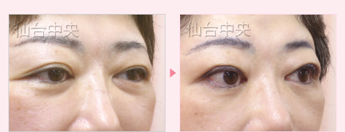 埋没法を繰り返したが希望の目にならなかった 症例写真5