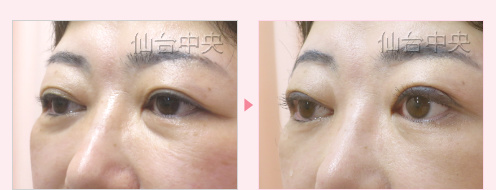埋没法を繰り返したが希望の目にならなかった 症例写真6