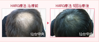 HARG療法