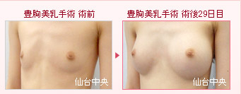 豊胸美乳手術