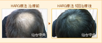 HARG療法