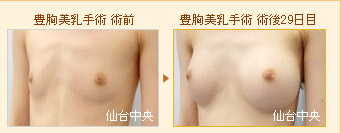 豊胸美乳手術